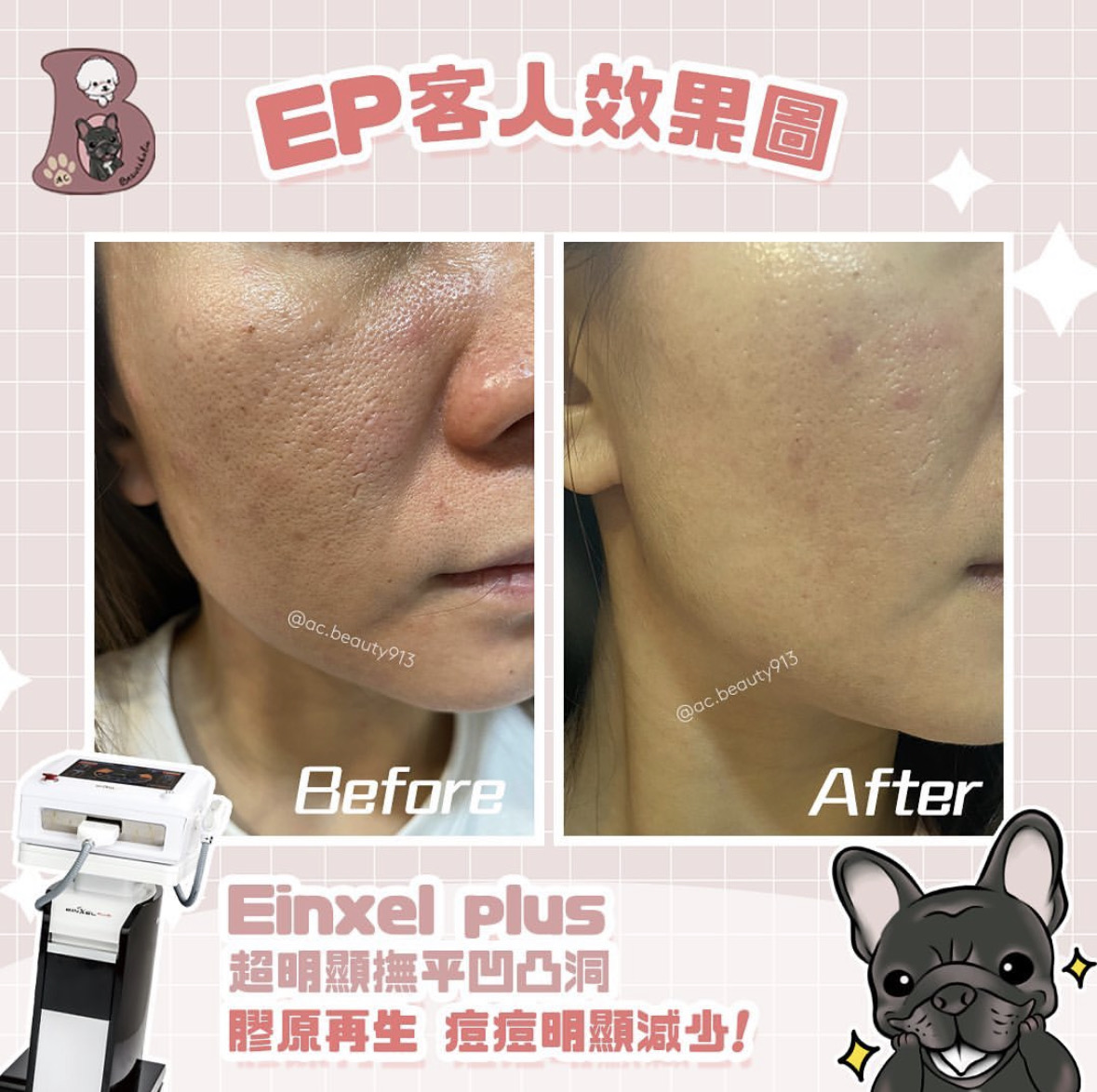 EP 微針射頻殫平凹凸洞月球肌 客戶見證 療程介紹 1