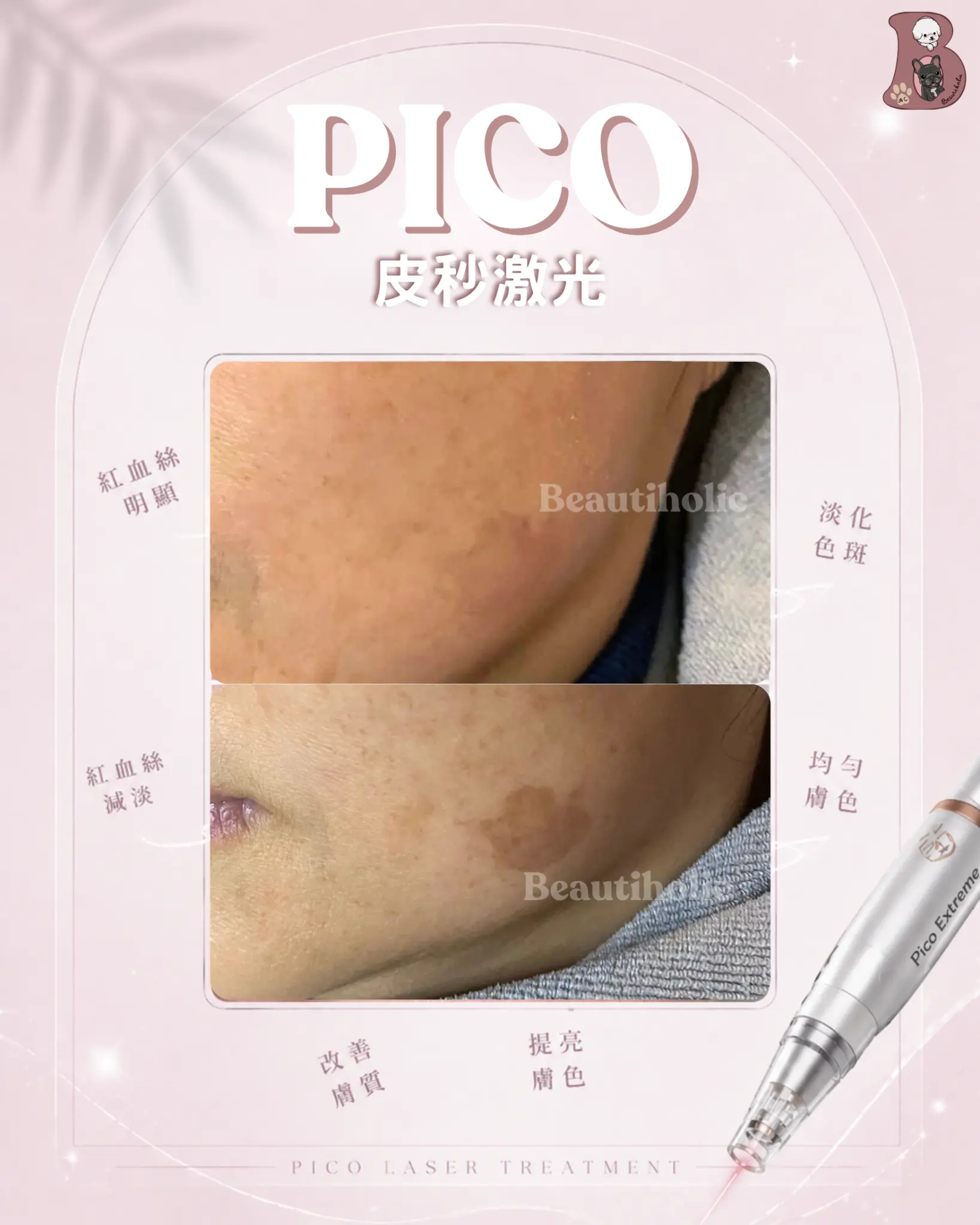 Pico 皮秒激光 客戶見證 療程介紹 1