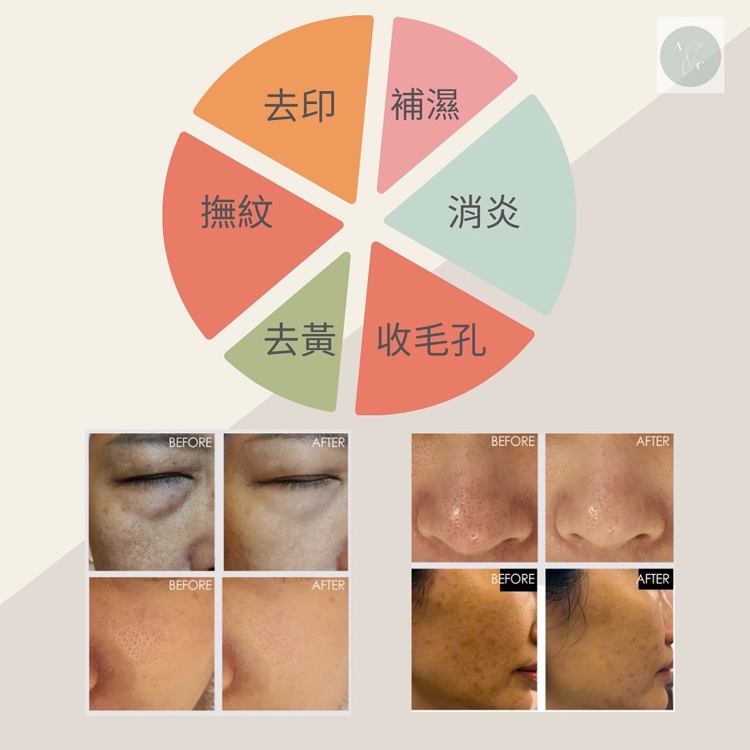 Plasonic 消炎細胞機 介紹 2